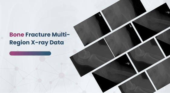 Multi-Region Bone Fracture