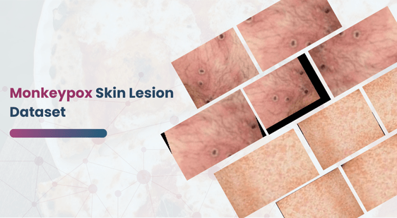 Monkeypox Skin Lesion Dataset